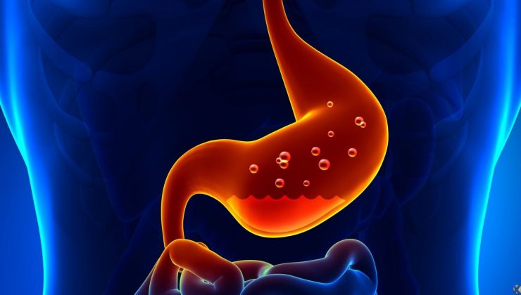 Gastrit nedir, Gastrit belirtileri nelerdir, Tedavi yöntemleri