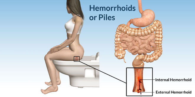 Hemoroid (Basur) Nedir ? Hemoroid Belirtileri ve Tedavisi