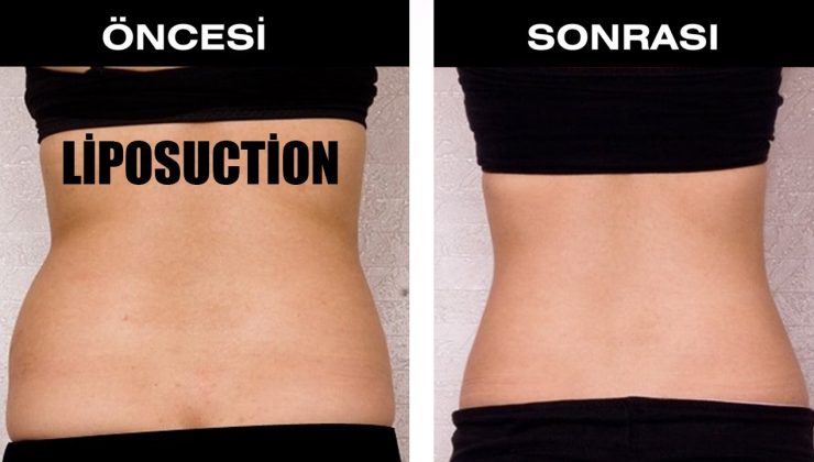 Liposuction Nedir, Nasıl Yapılır, Kimlere Uygulanır, Fiyatları