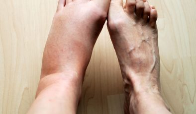 Yürürken ayak bileği şişmesi ve ağrısı nasıl geçer ?