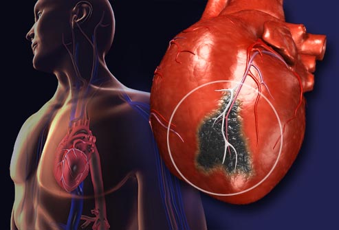 Kalp Krizi Nedir? Kalp Krizi Belirtileri Nelerdir?