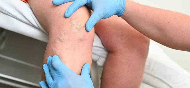 Varis Nedir? Belirti Ve Tedavi Yöntemleri Nelerdir?