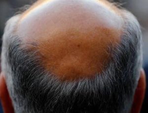 Erkeğe ‘Kel’ Demek Cinsel Taciz Sayıldı!