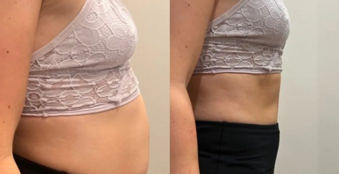 Ödem Atıcı ve Hızlı Ödem Söktürücü Yöntemler Nelerdir?